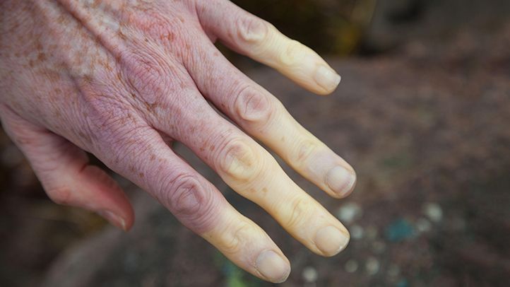 Signs and Symptoms of Lupus